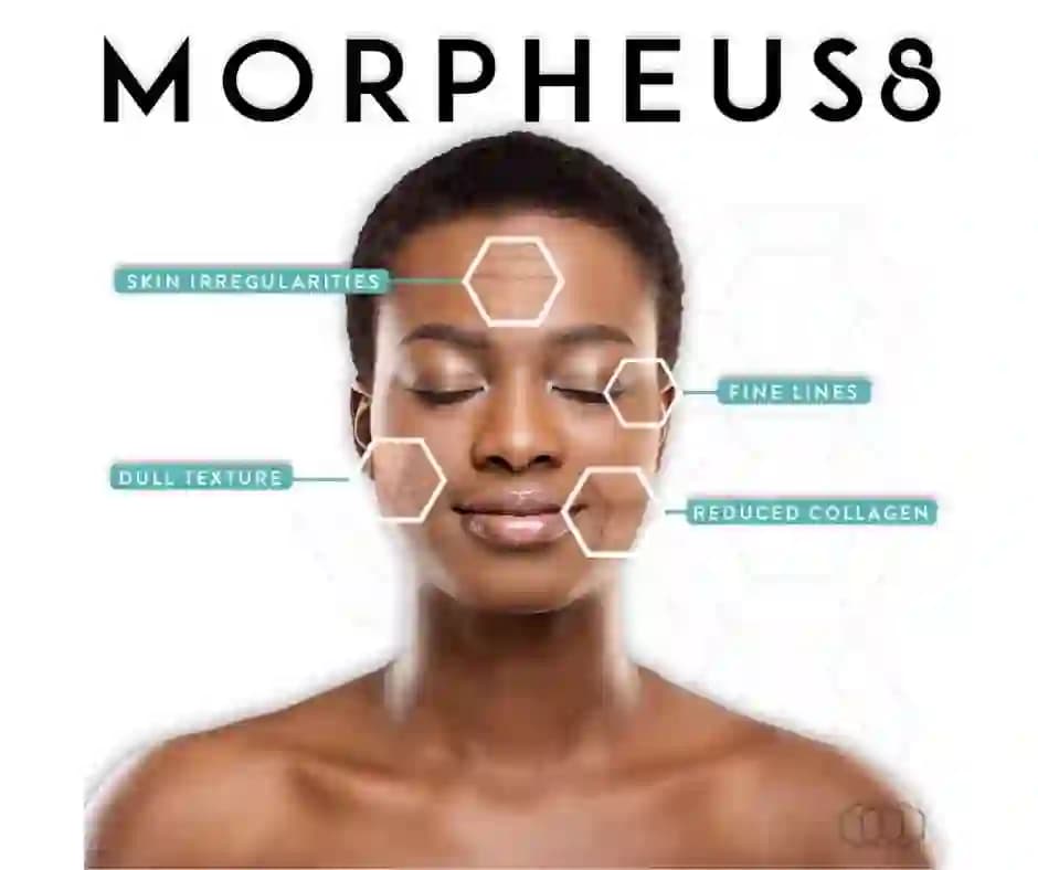 Skin concerns Morpheus8 treats: skin irregularities, fine lines, dull texture, reduced collagen